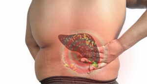 Bệnh xơ gan có mấy loại? Cách phát hiện và điều trị