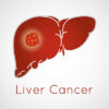 Ung thư gan